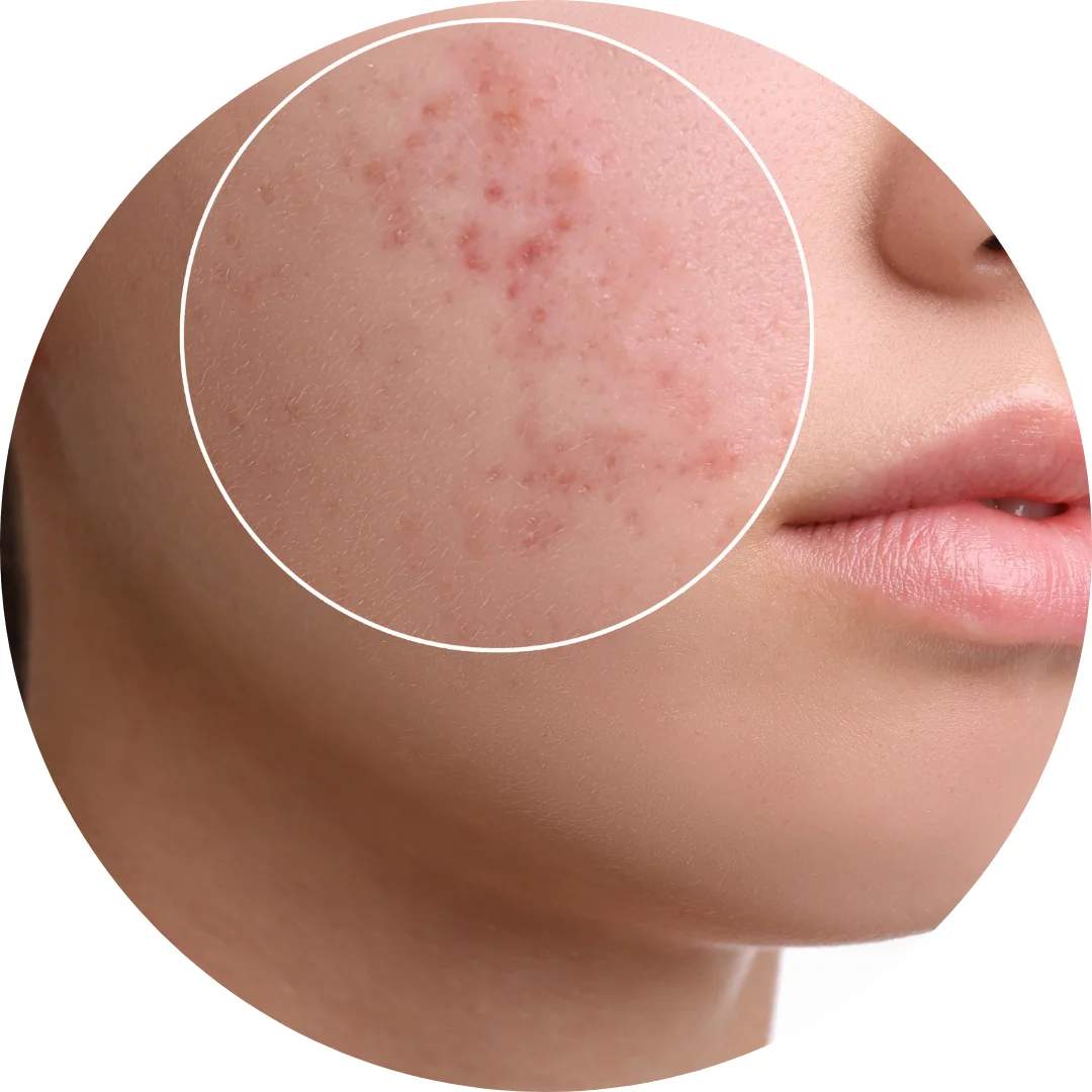Acne & Blemish Control