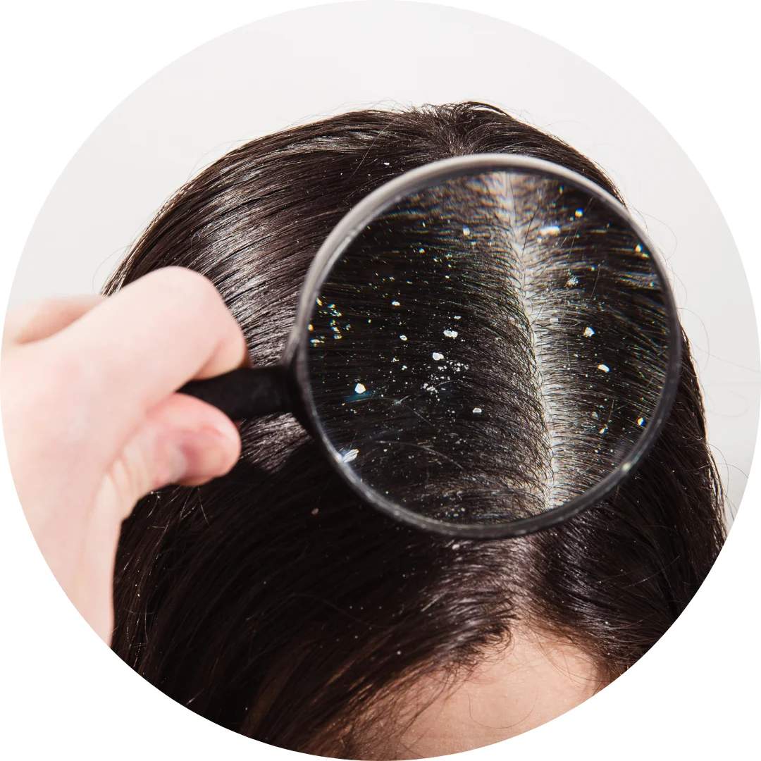 Dandruff Free