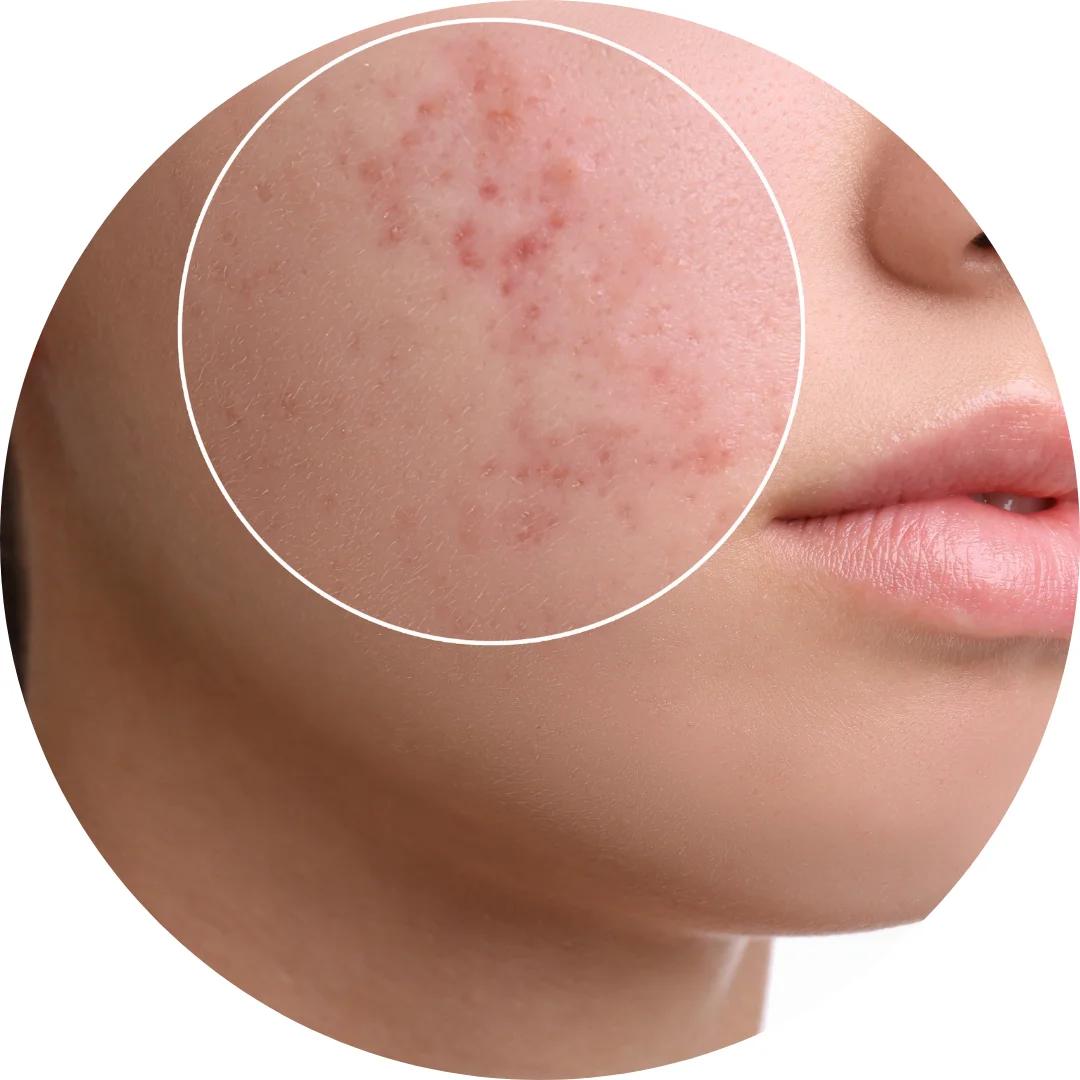 Acne & Blemish Control